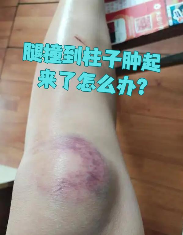 腿撞肿了怎么办