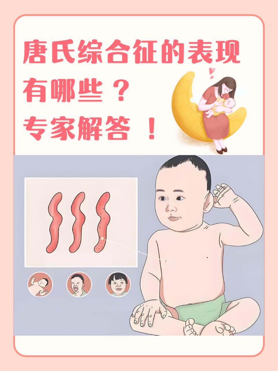 什么是唐氏综合症