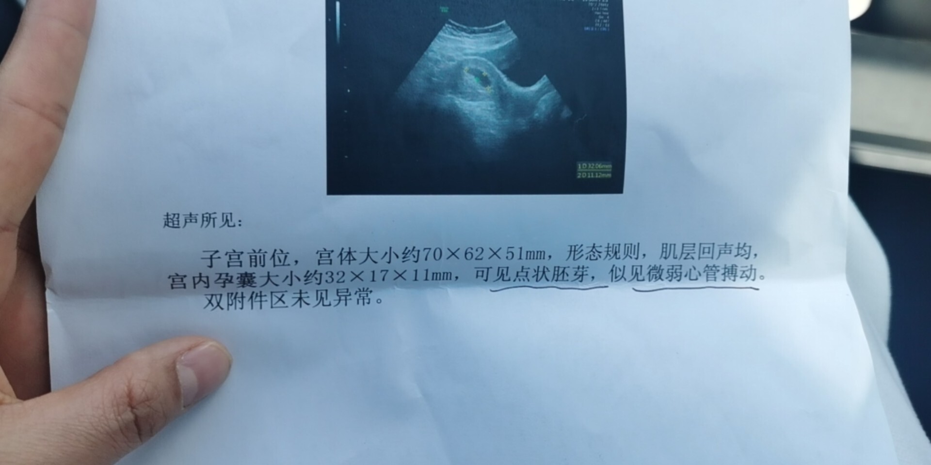 怀孕50天孕囊大小是多少