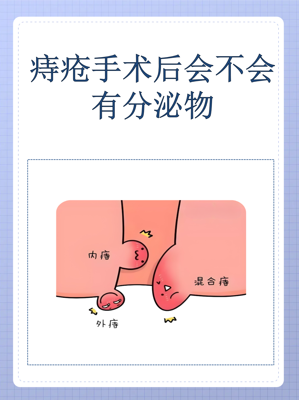 痔疮手术几天恢复