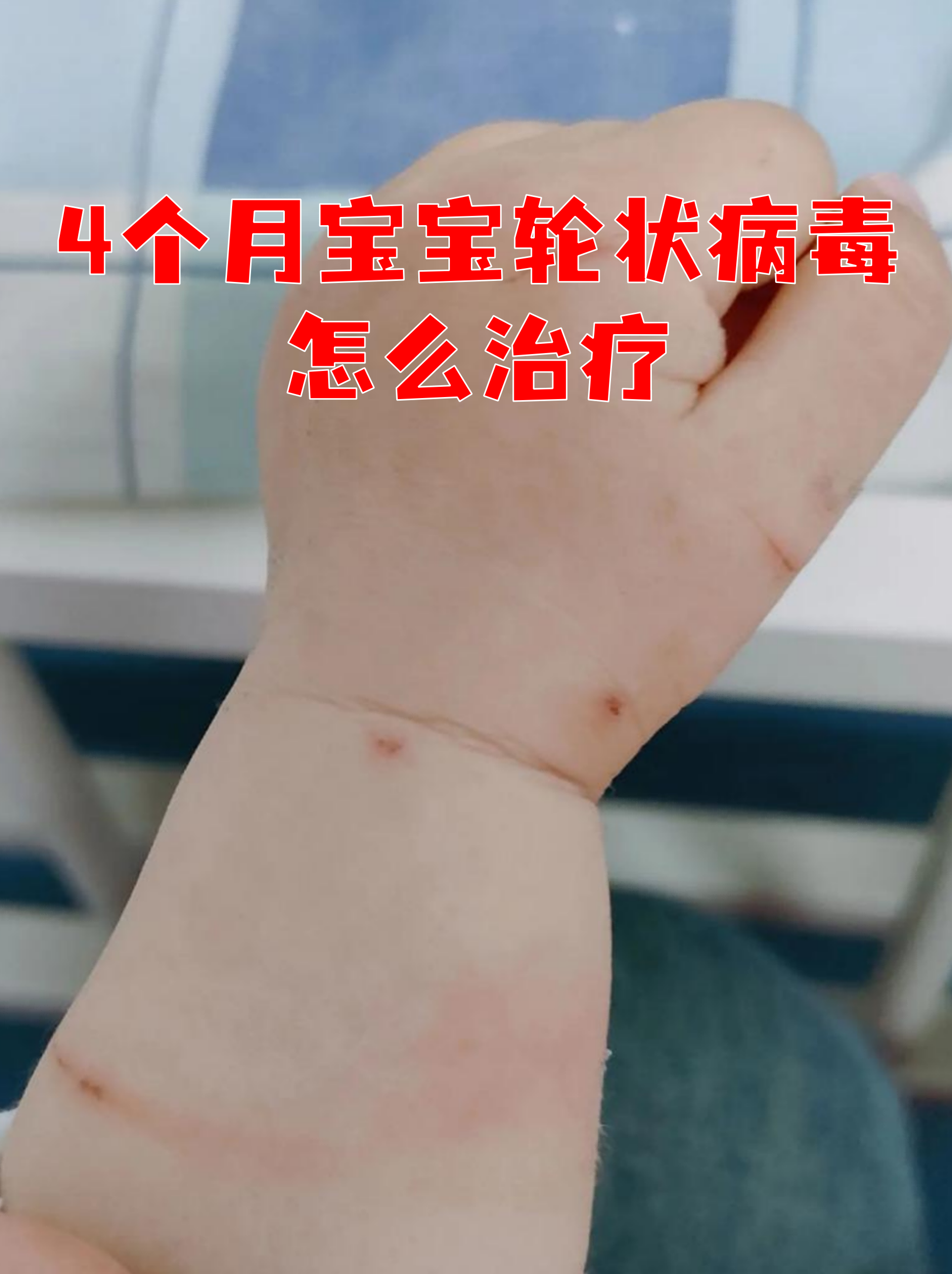 轮状病毒感染表现