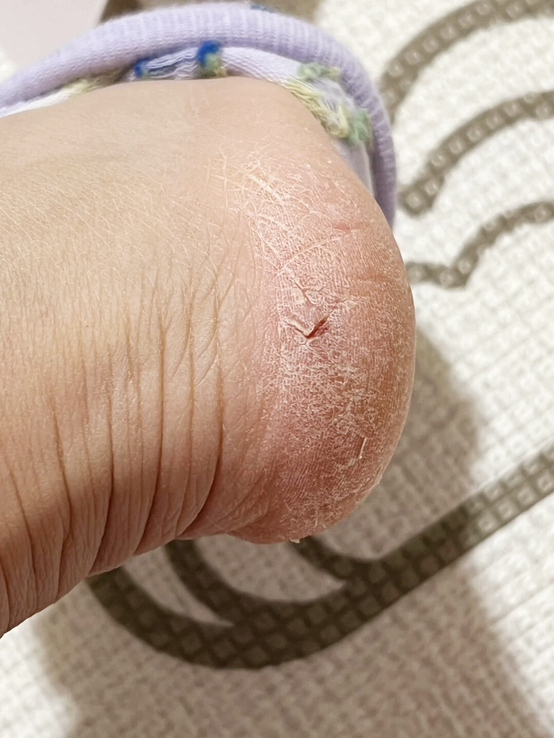 脚干裂起硬皮怎么办