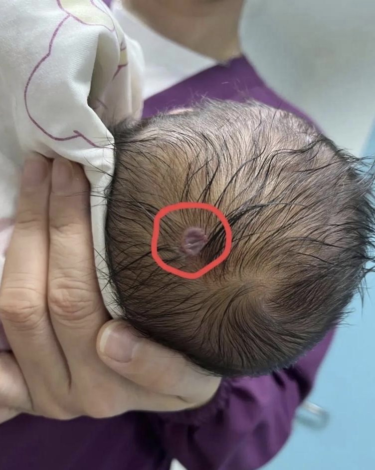 头后脑勺头皮上长个疙瘩一摁就疼怎么回事