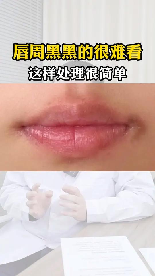 嘴巴周围一圈黑怎么办