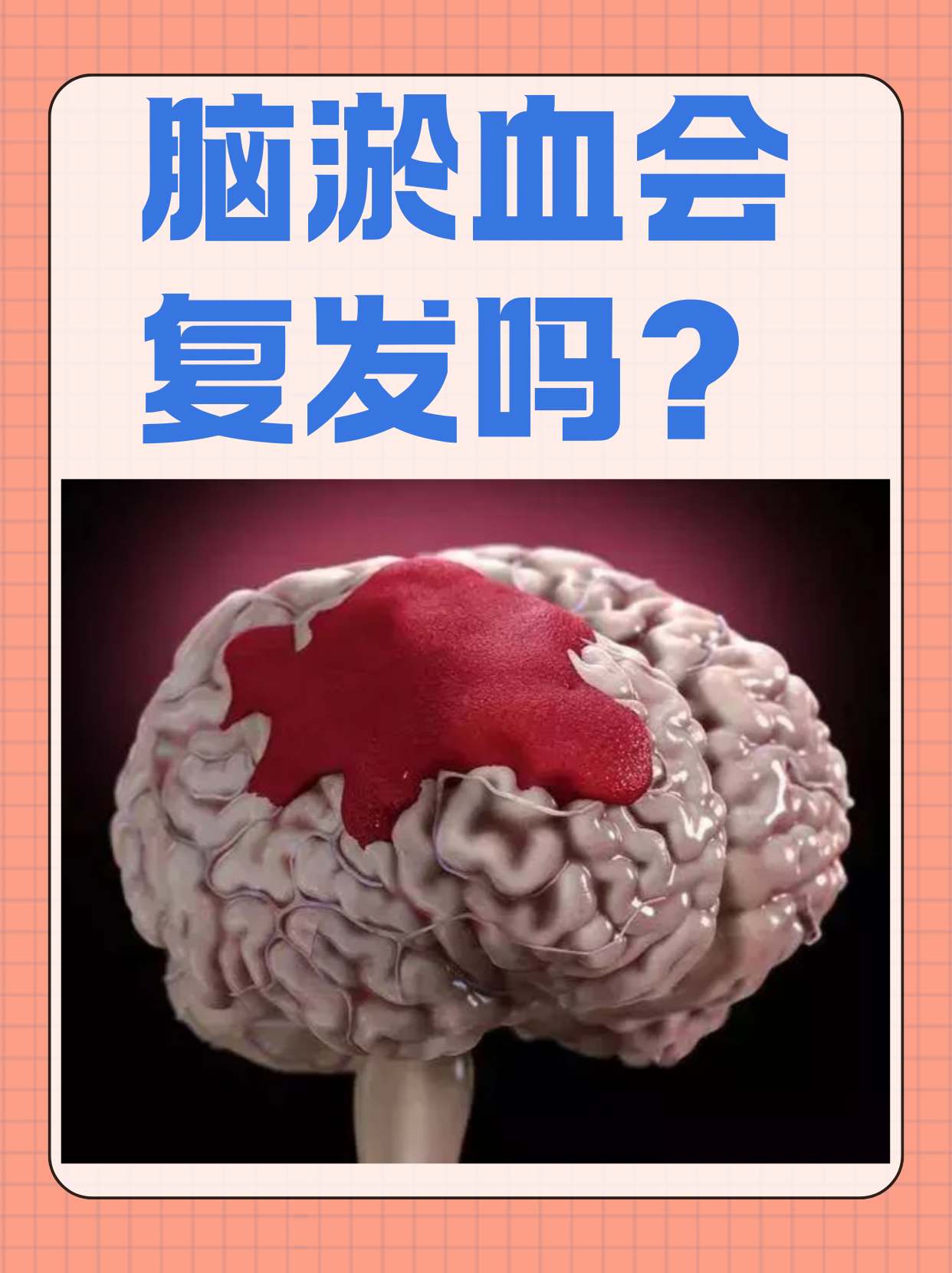脑溢血什么引起的