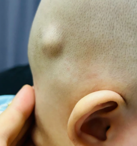 头上有个肉疙瘩严重吗?