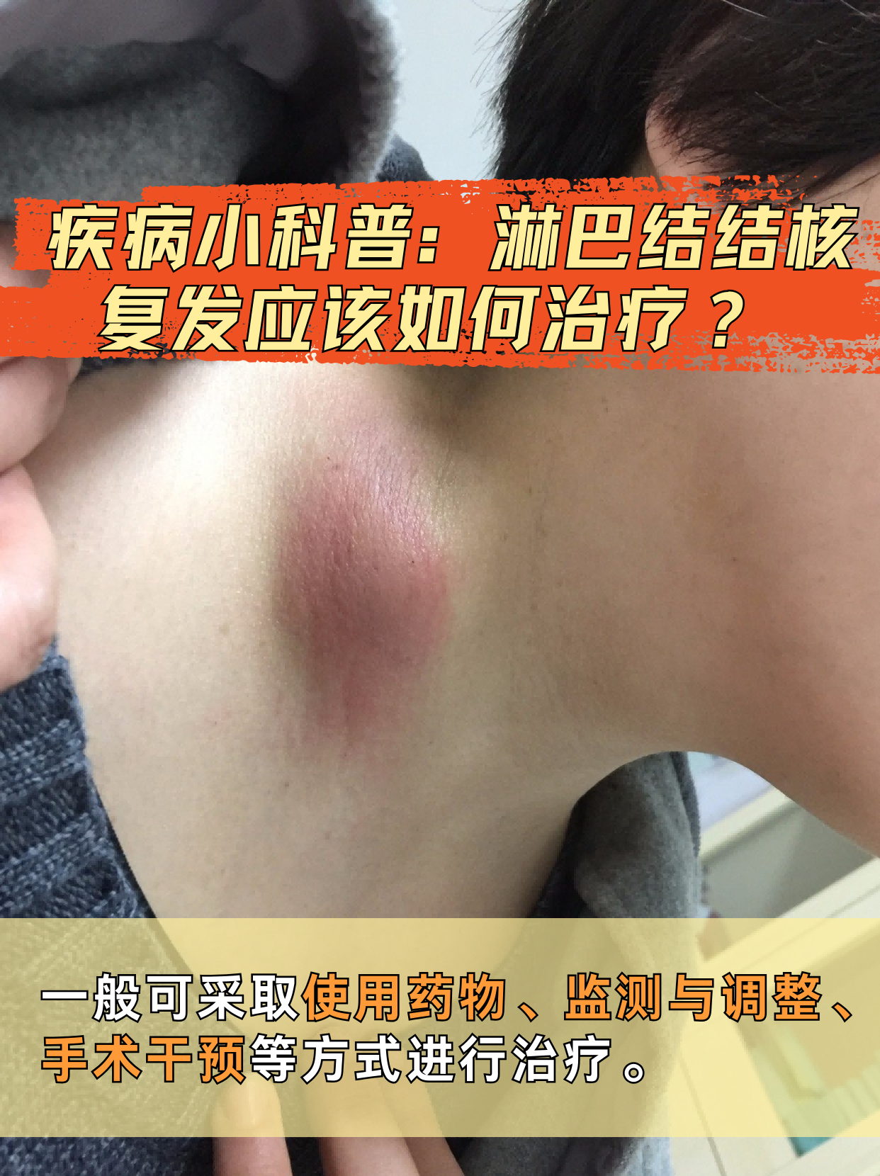 淋巴结发炎严重吗怎样治疗