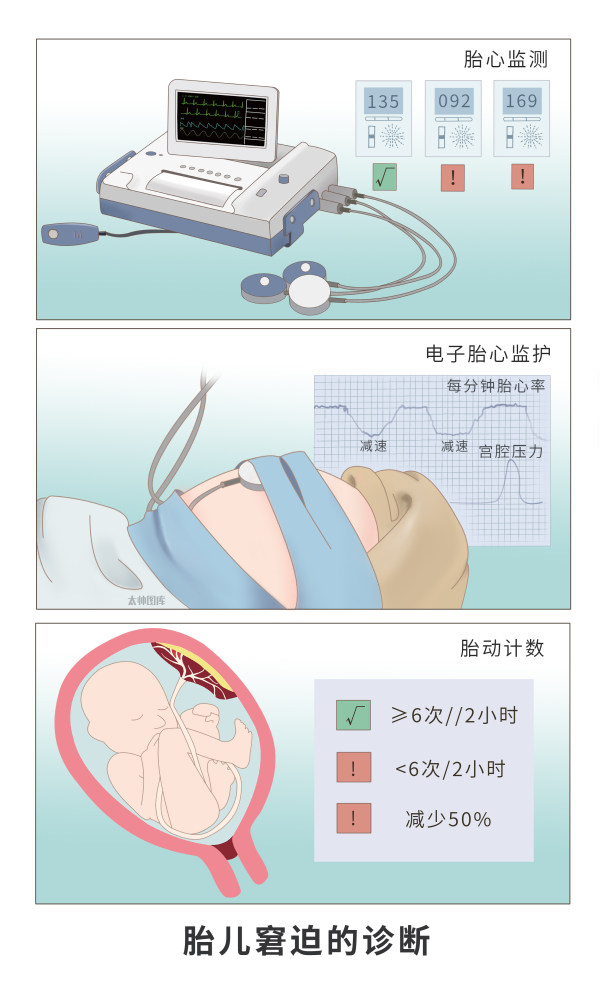 胎儿窘迫的表现