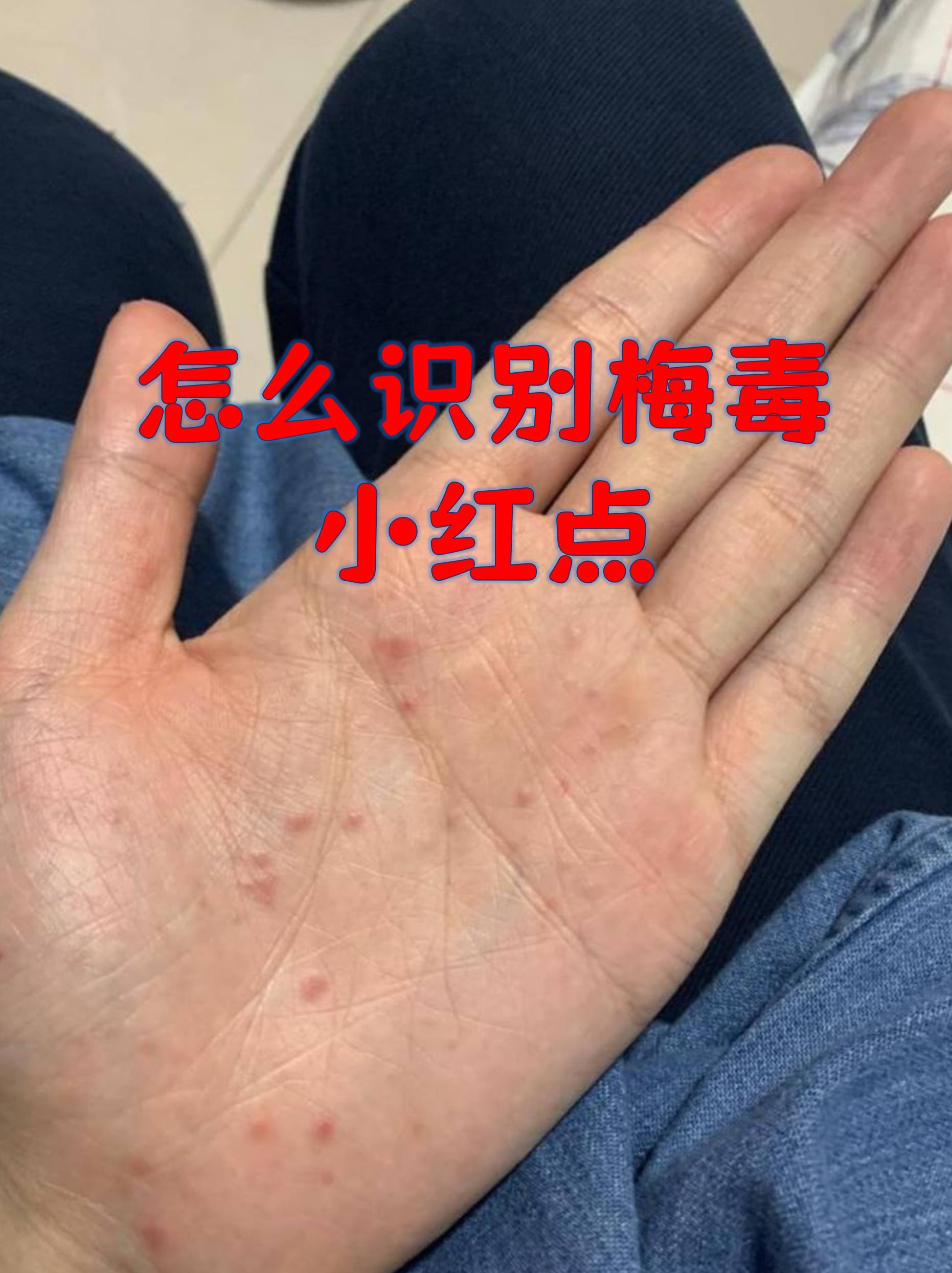 手上小红点怎么办