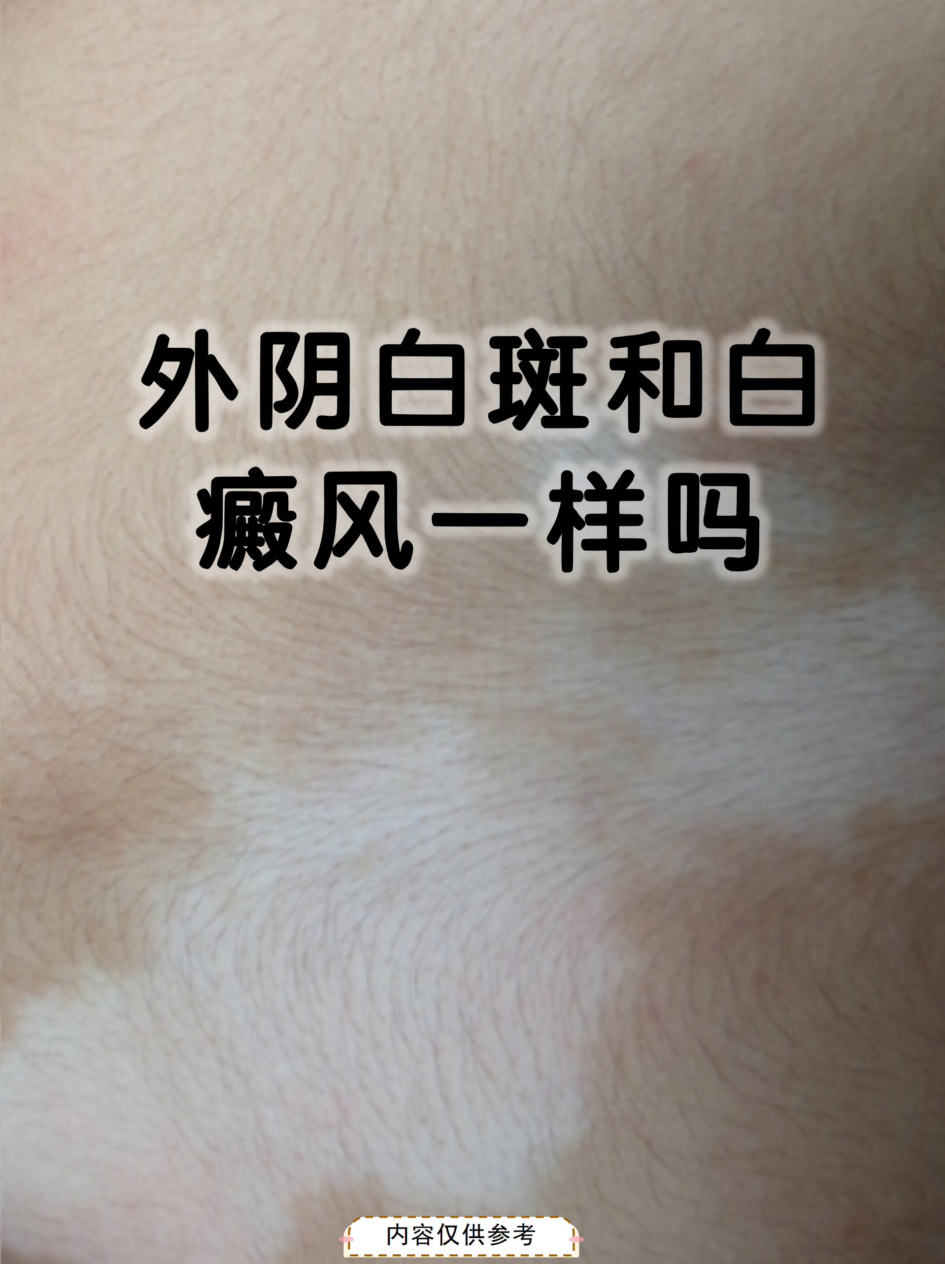 白癜风有什么症状呢?