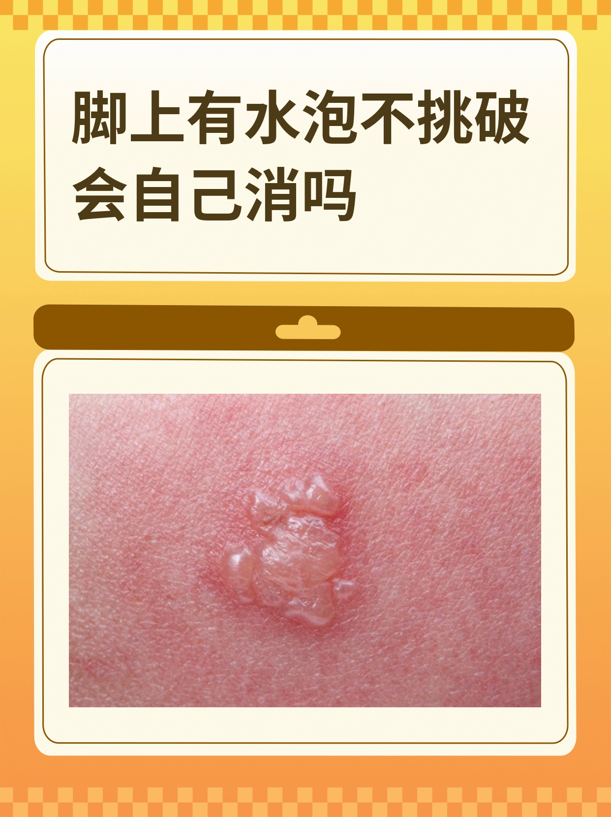 脚起泡了怎么办