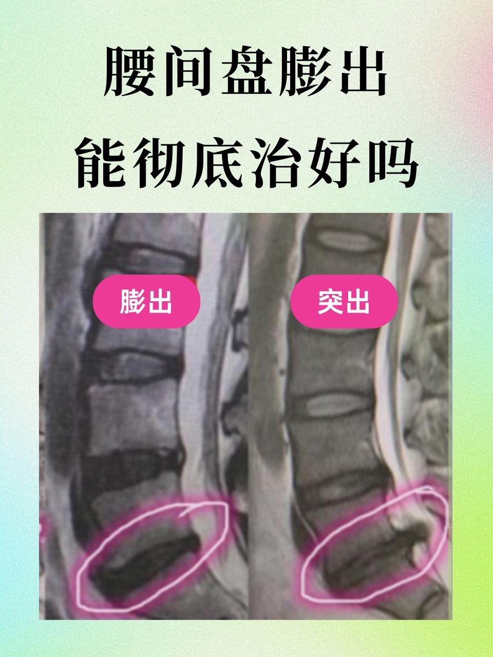 腰椎骨质增生的症状有哪些?