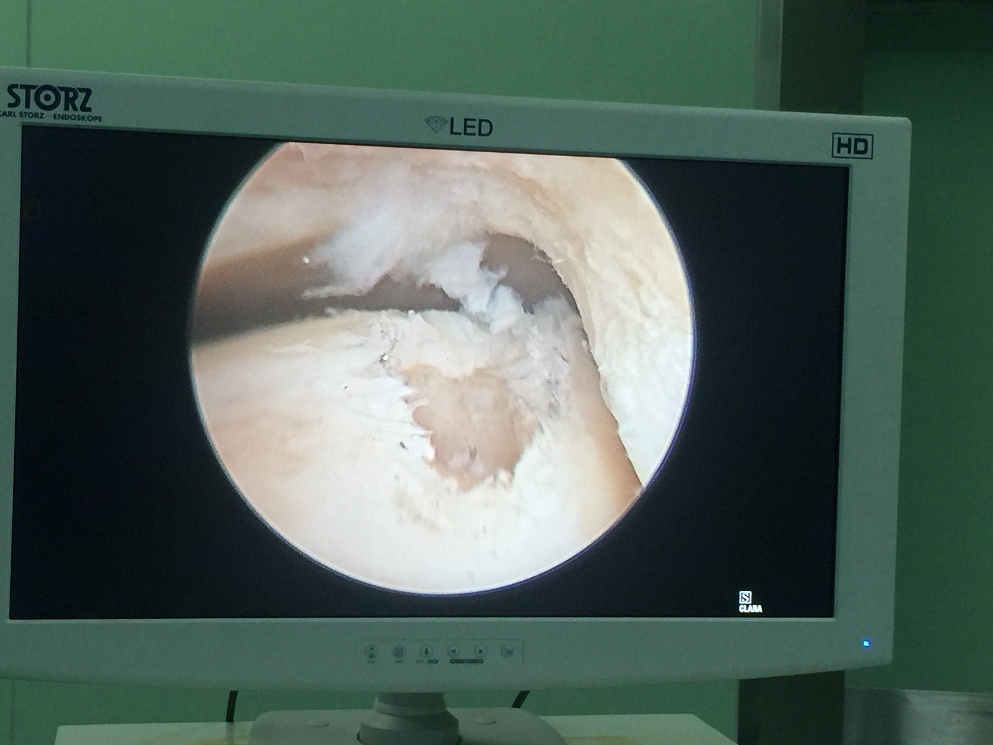 距骨坏死严重吗