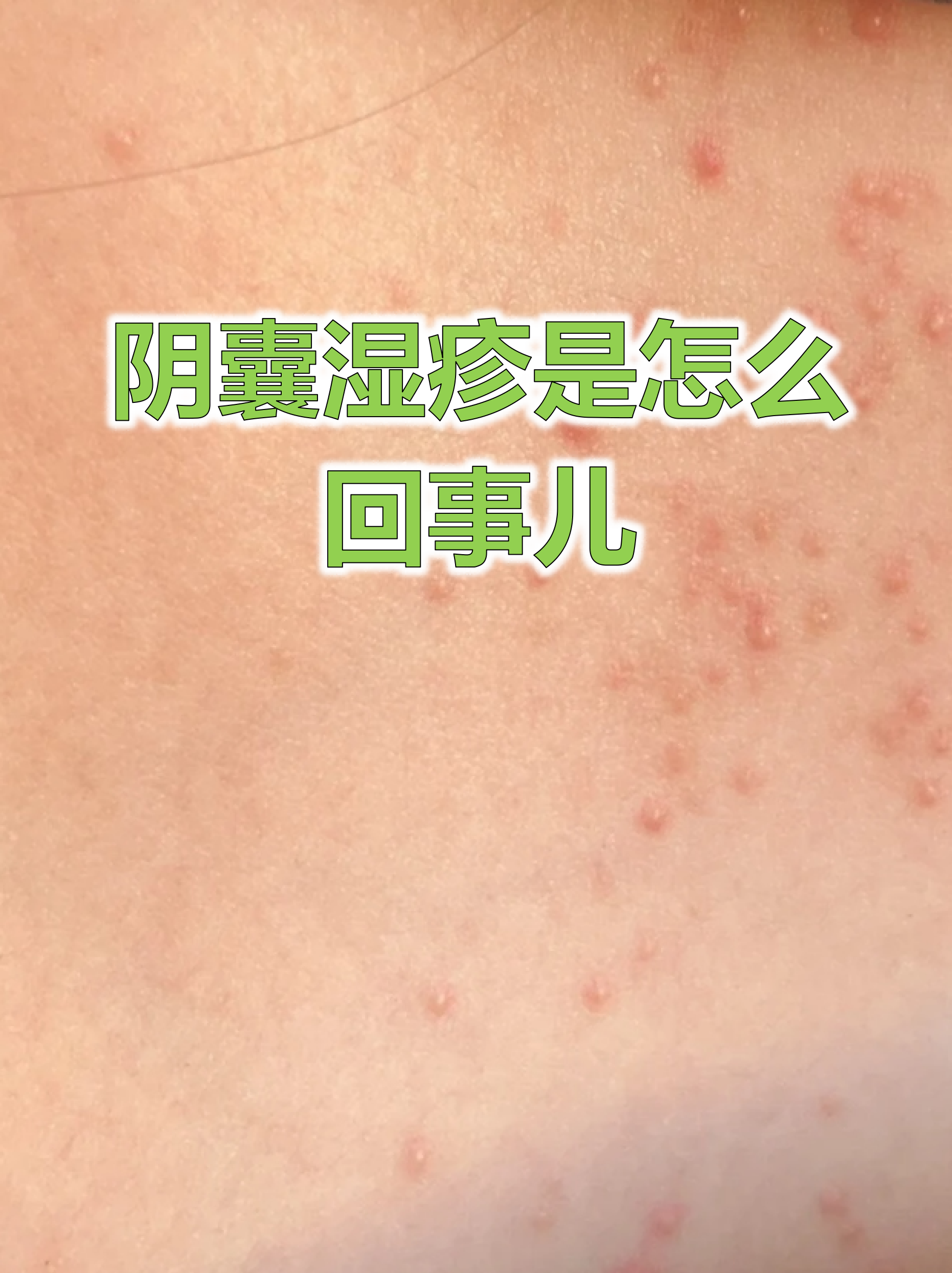 阴囊大面积的白色颗粒