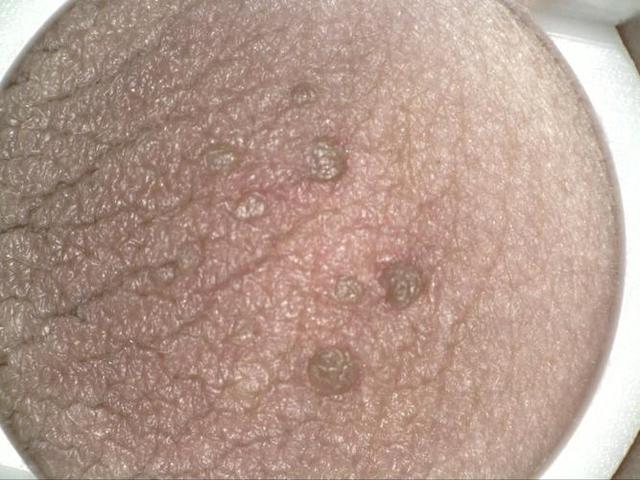 阴囊大面积的白色颗粒