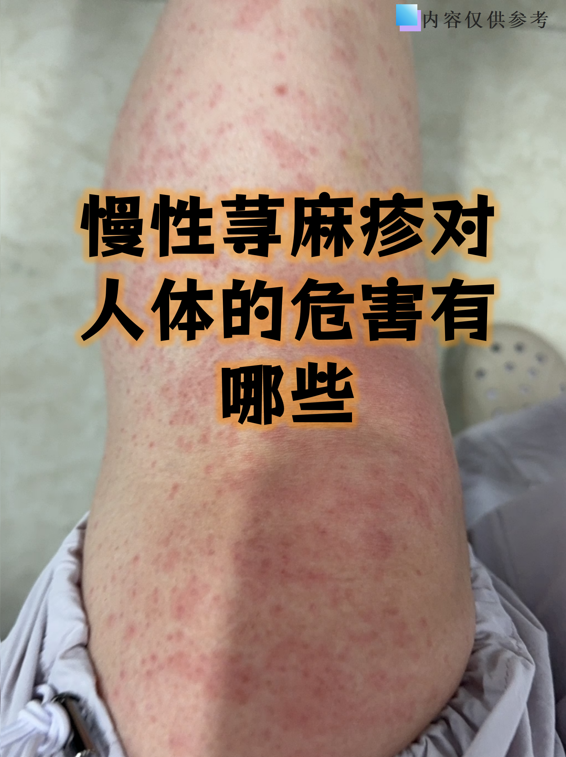 慢性荨麻疹的自愈周期