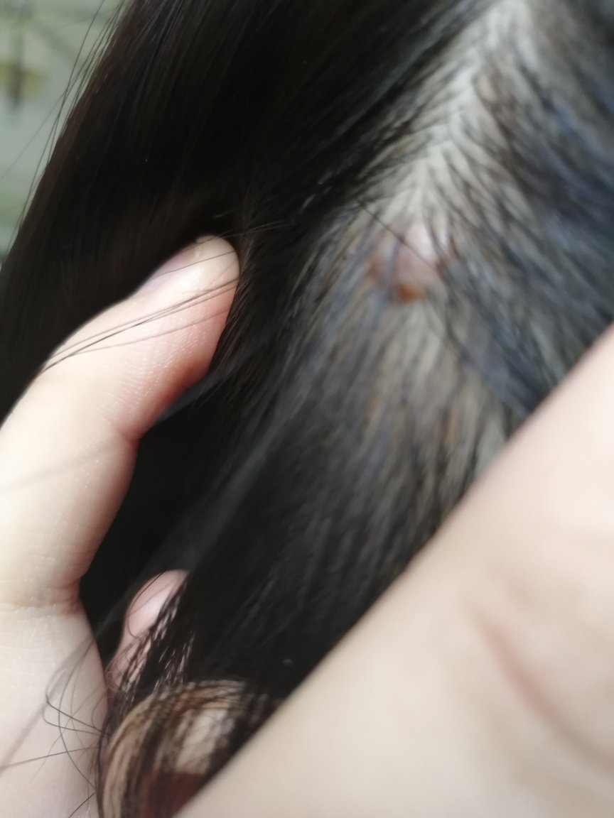 头上长了个硬包,按压很疼