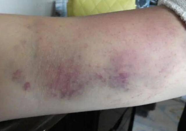 慢性白血病的早期症状有哪些?