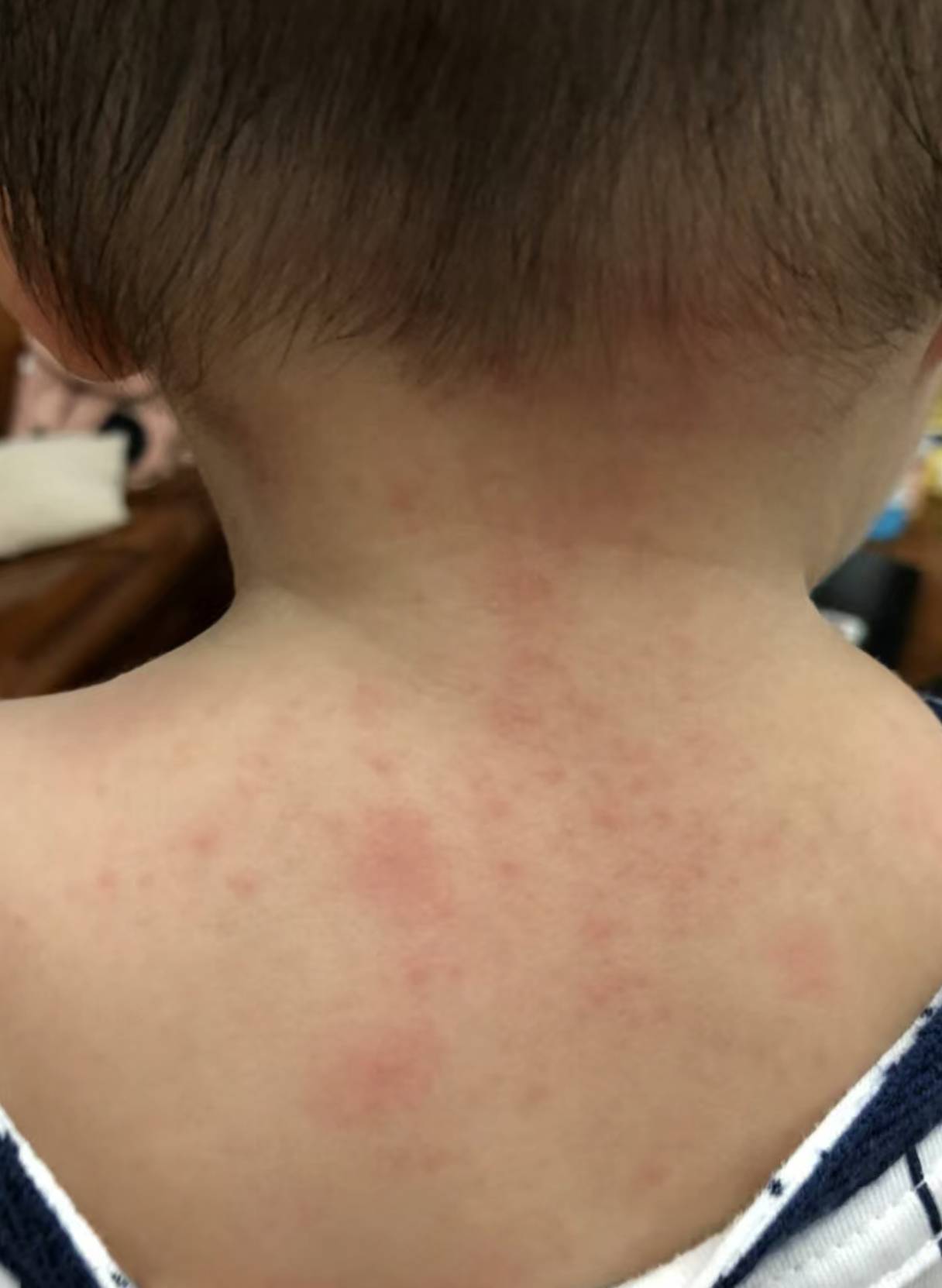 小朋友长痱子怎么办?