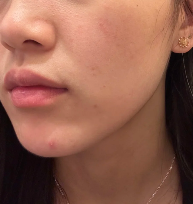 化妆品过敏严重几天能好?