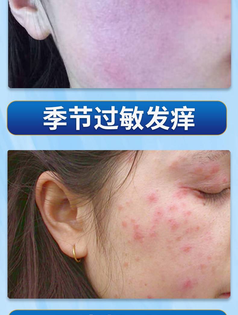 化妆品过敏严重几天能好?