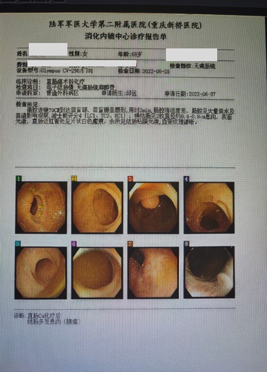 肛管癌最佳治疗方案
