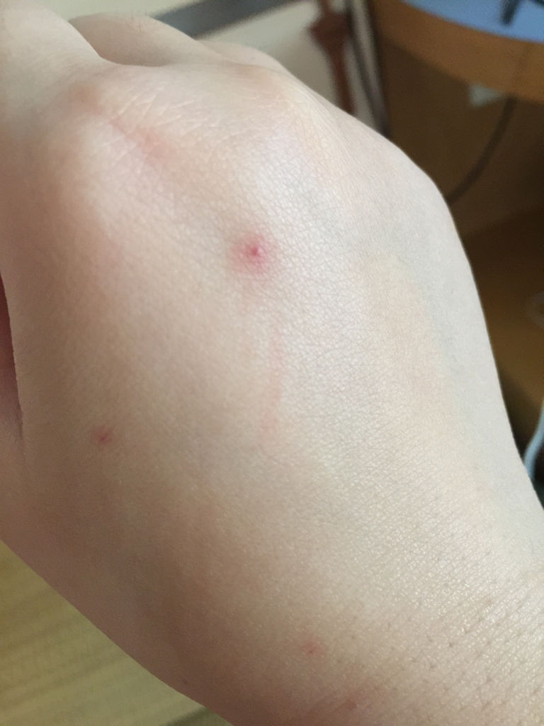 手上有红点,不痛不痒