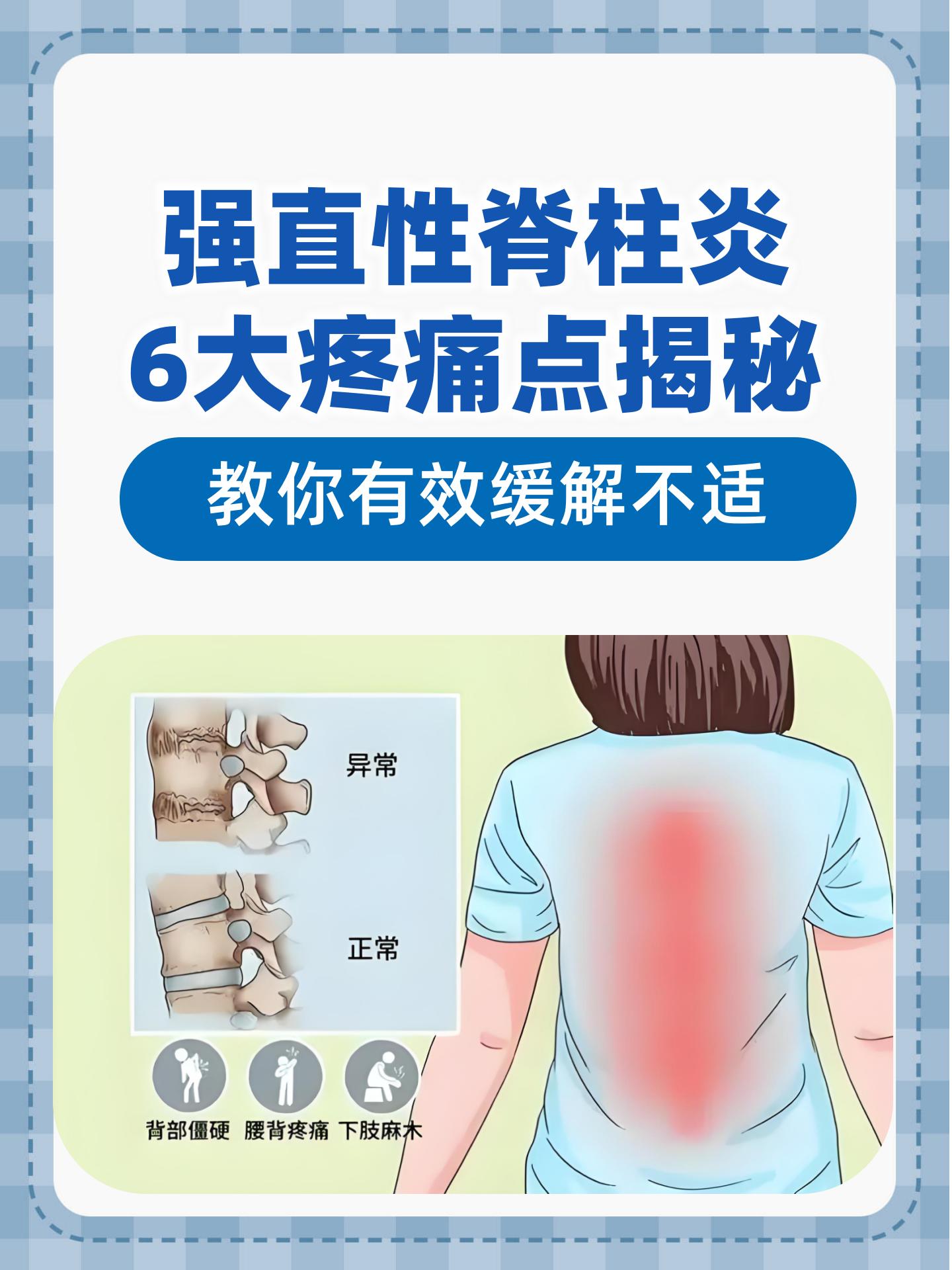 女性脊椎炎有什么症状