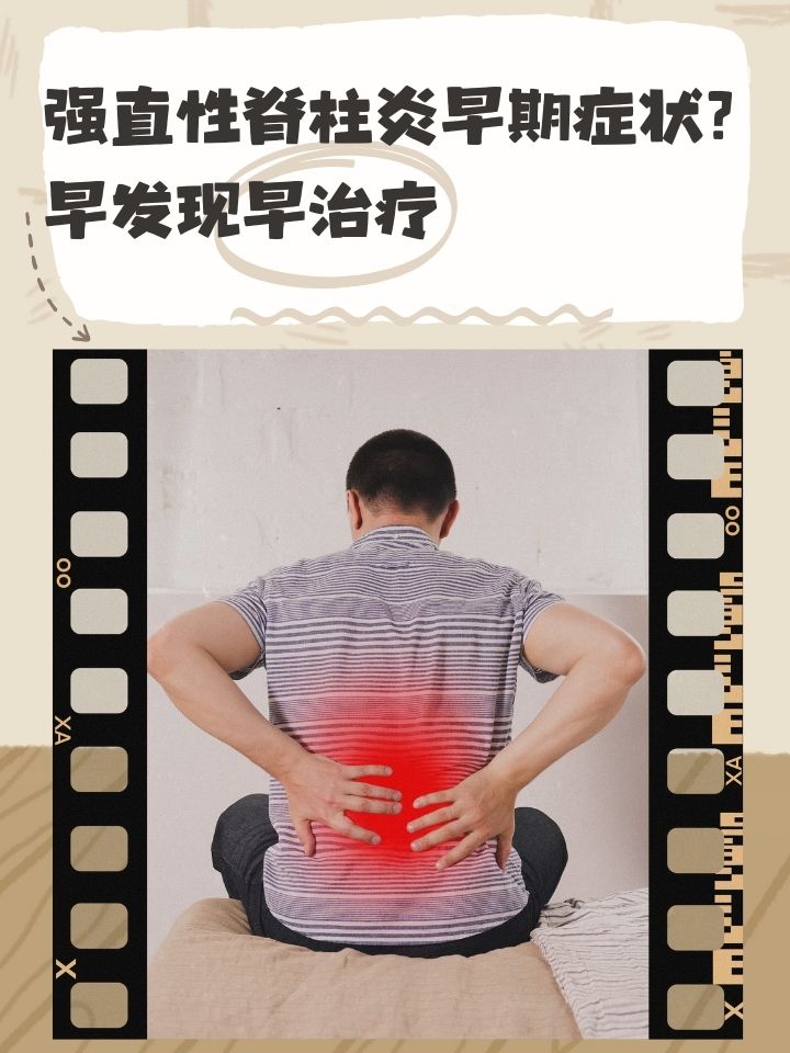 女性脊椎炎有什么症状