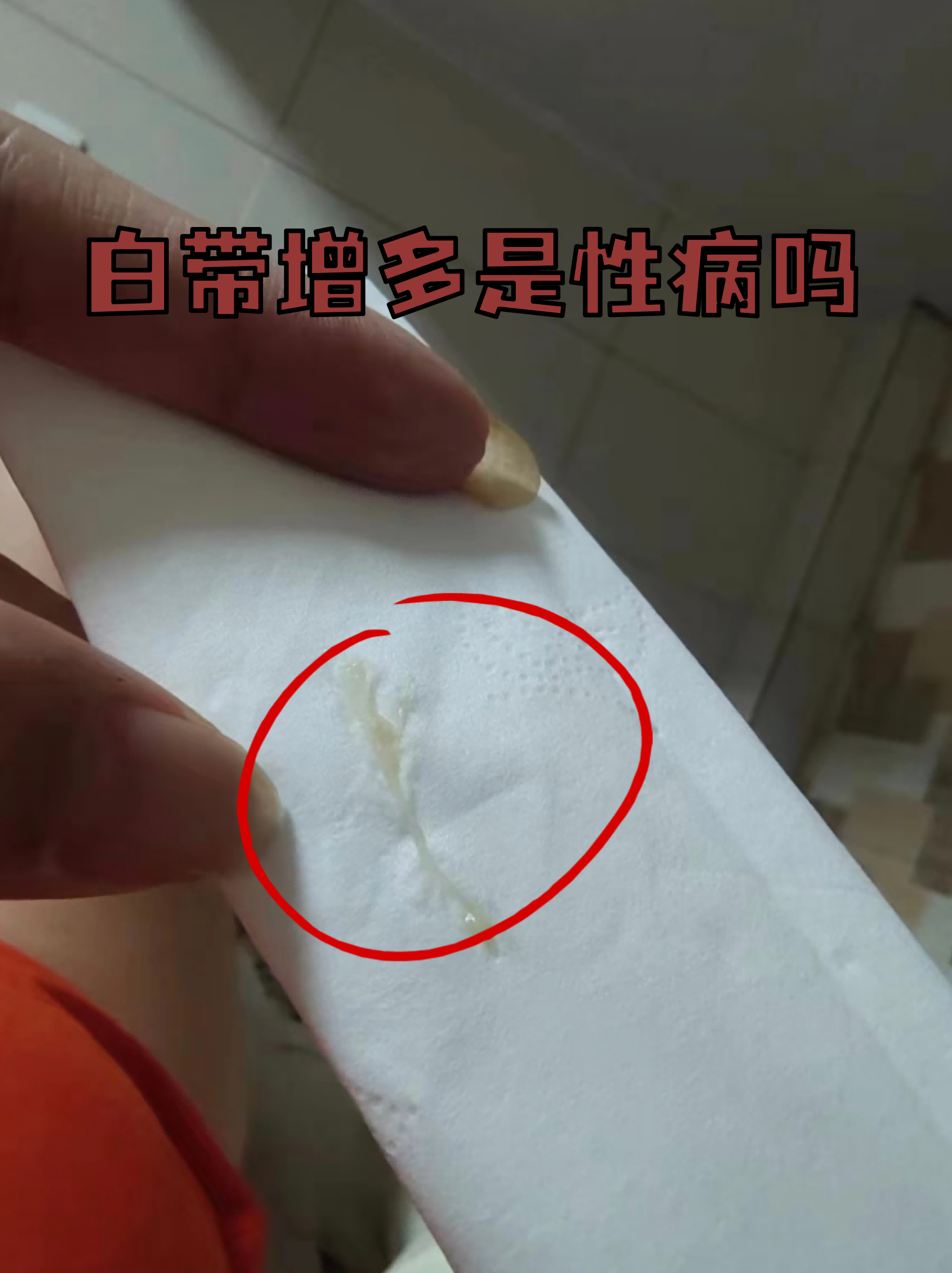 什么是豆腐渣白带