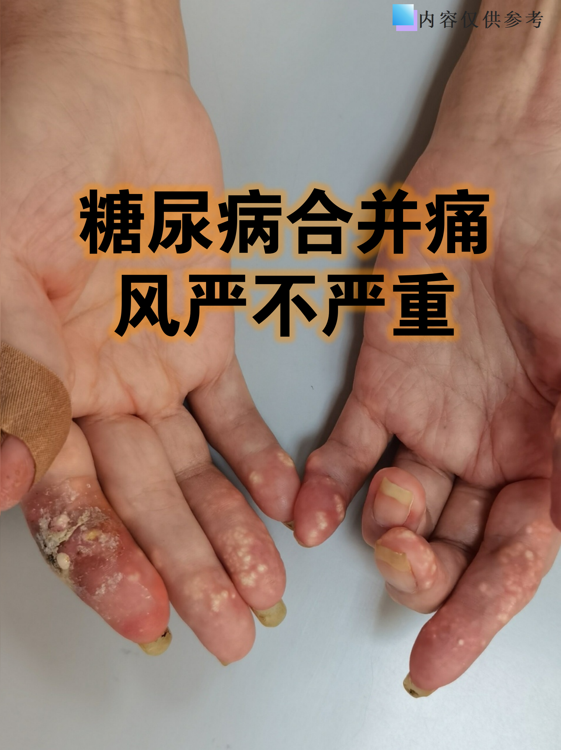 尿酸500多严重吗?