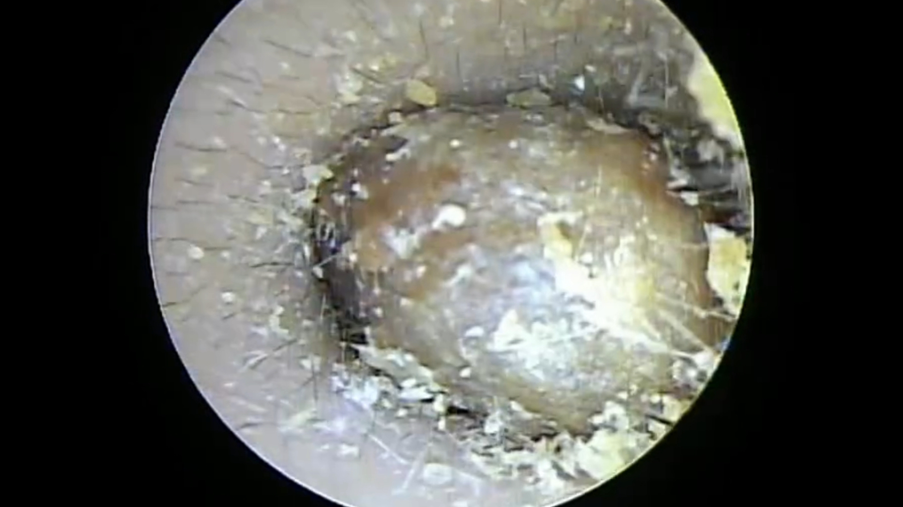 小孩耳屎变硬结块怎么办?