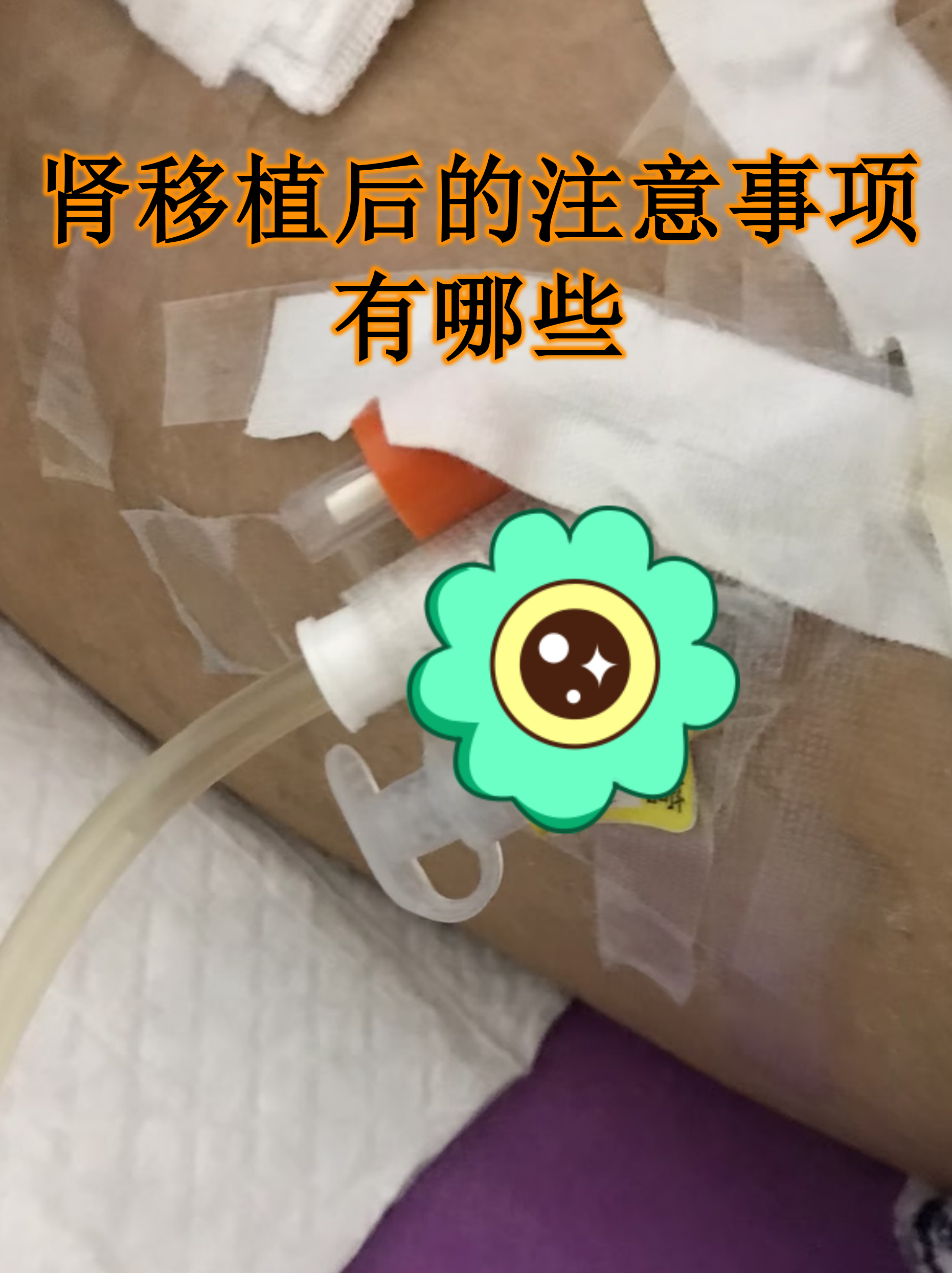 肾移植患者的注意事项