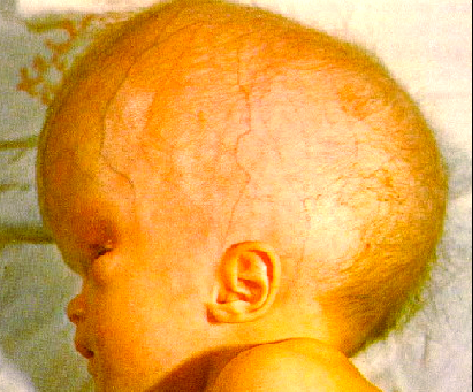 新生儿化脓性脑膜炎严重吗