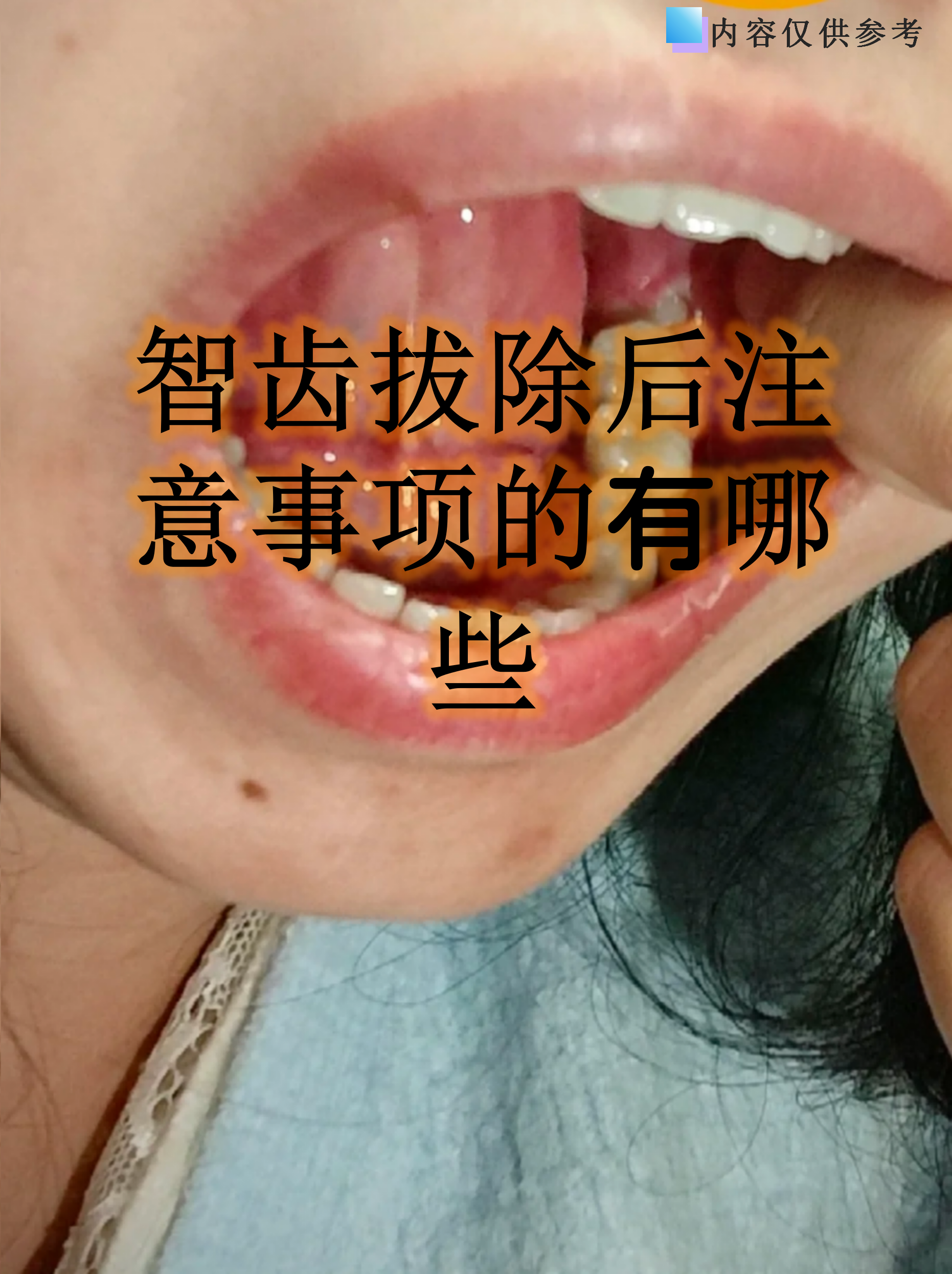 智齿必须拔吗