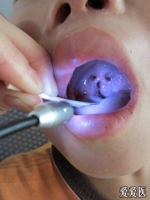 小舌头掉下来怎么办