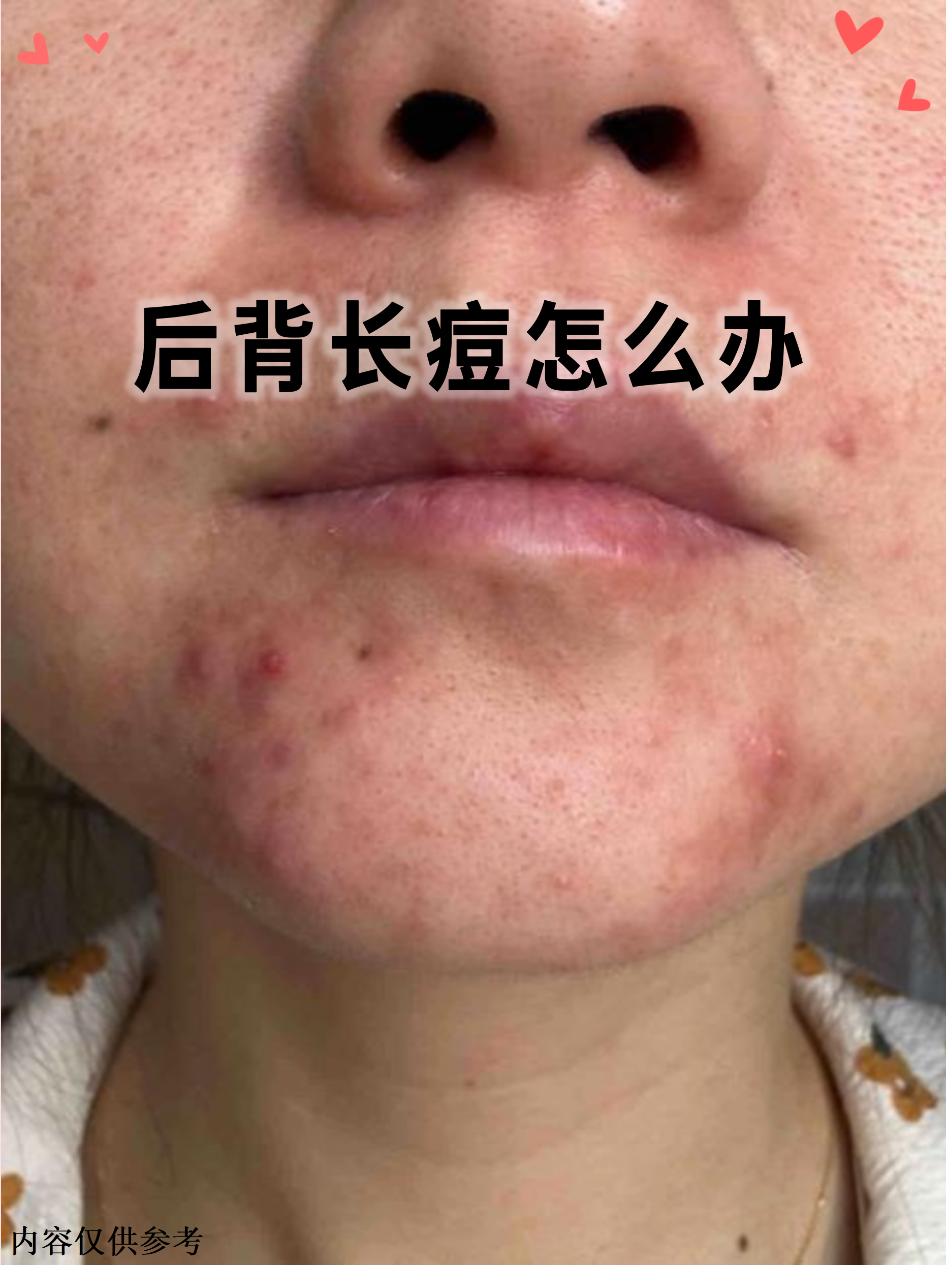 请问:背部毛孔里有颗粒物,应该怎么治疗?