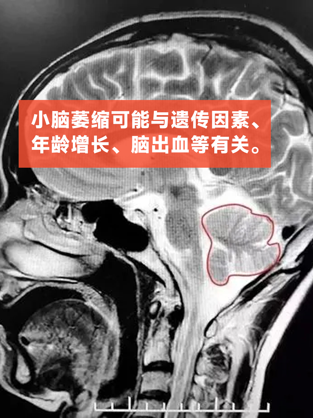 脑萎缩能治好吗?