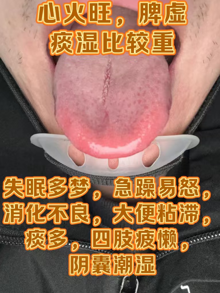 舌苔黄腻是怎么回事