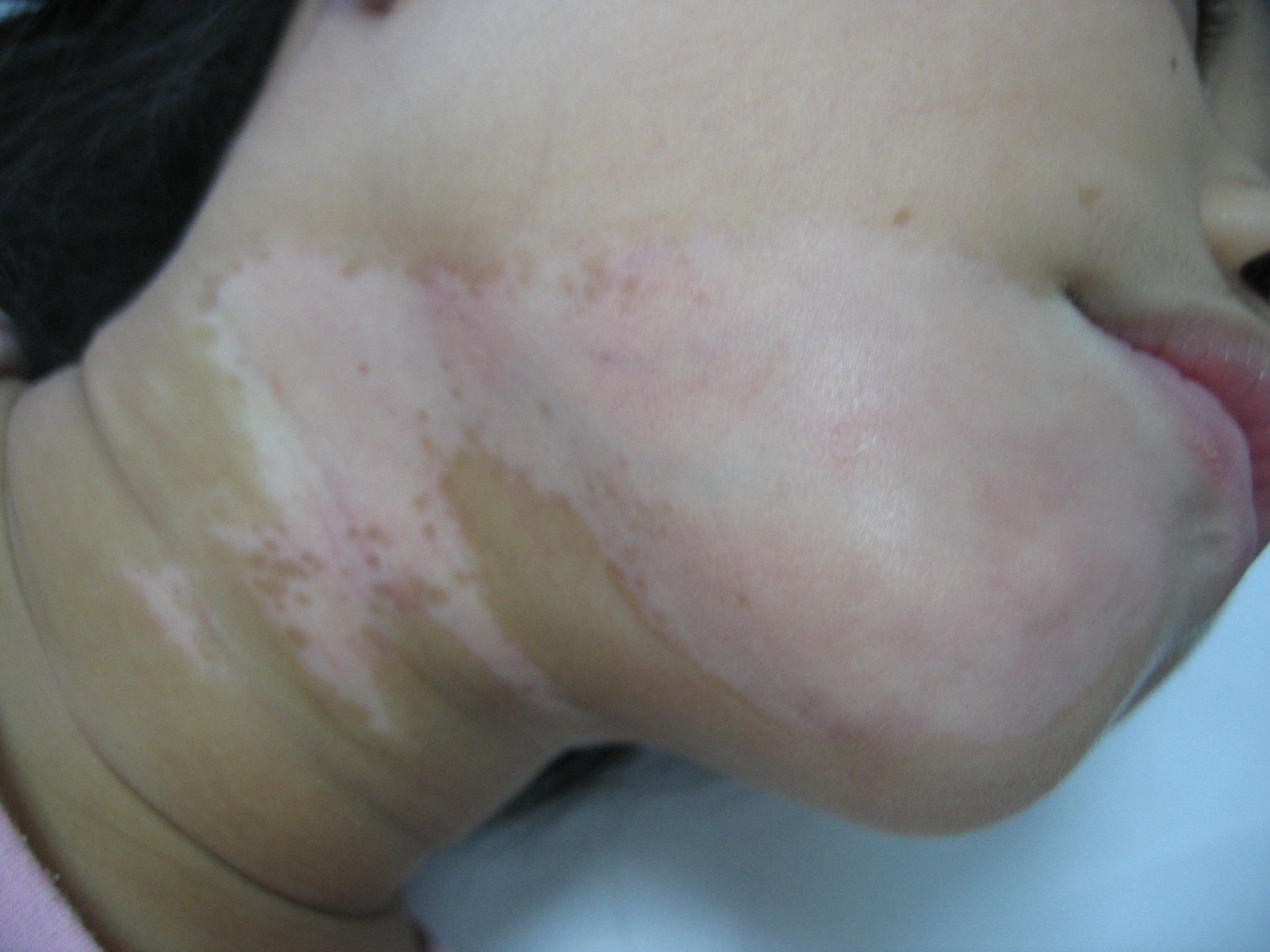 白癜风初期有什么症状