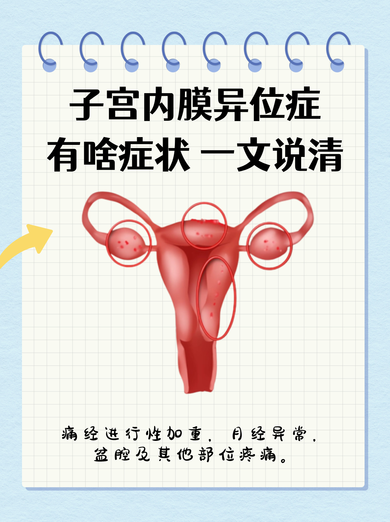 子宫内膜异位症什么原因引起的