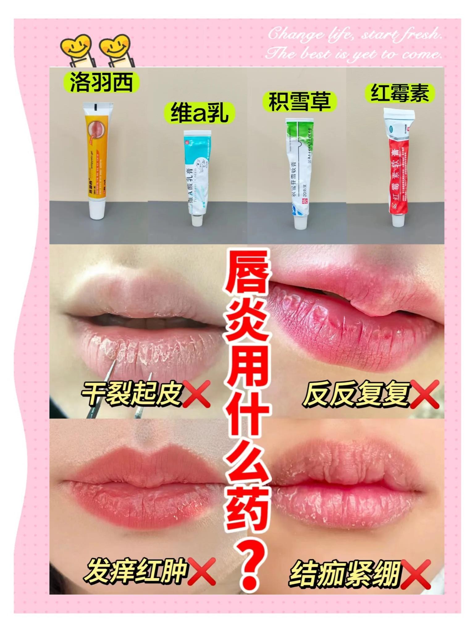 得了唇炎怎么治疗有效