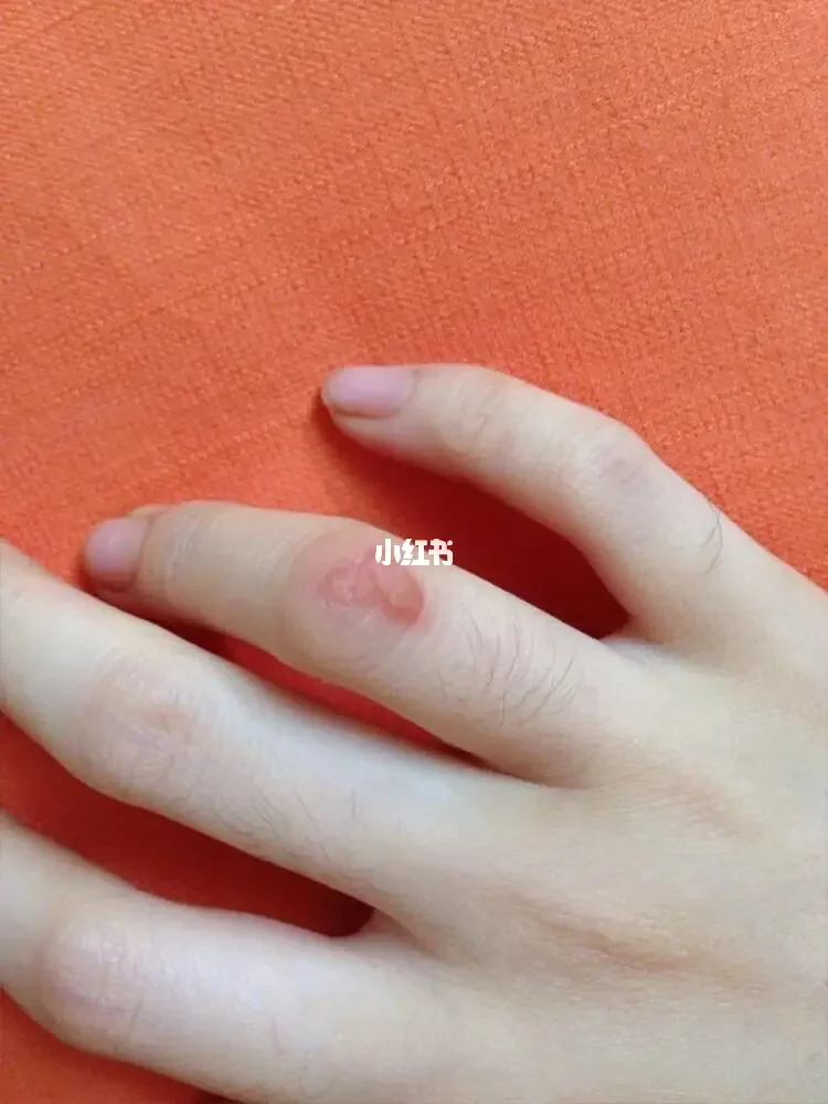 胸前红色痘痘不痛不痒