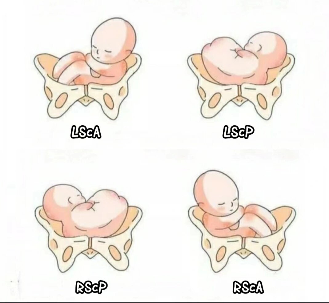 胎位LOT是什么意思