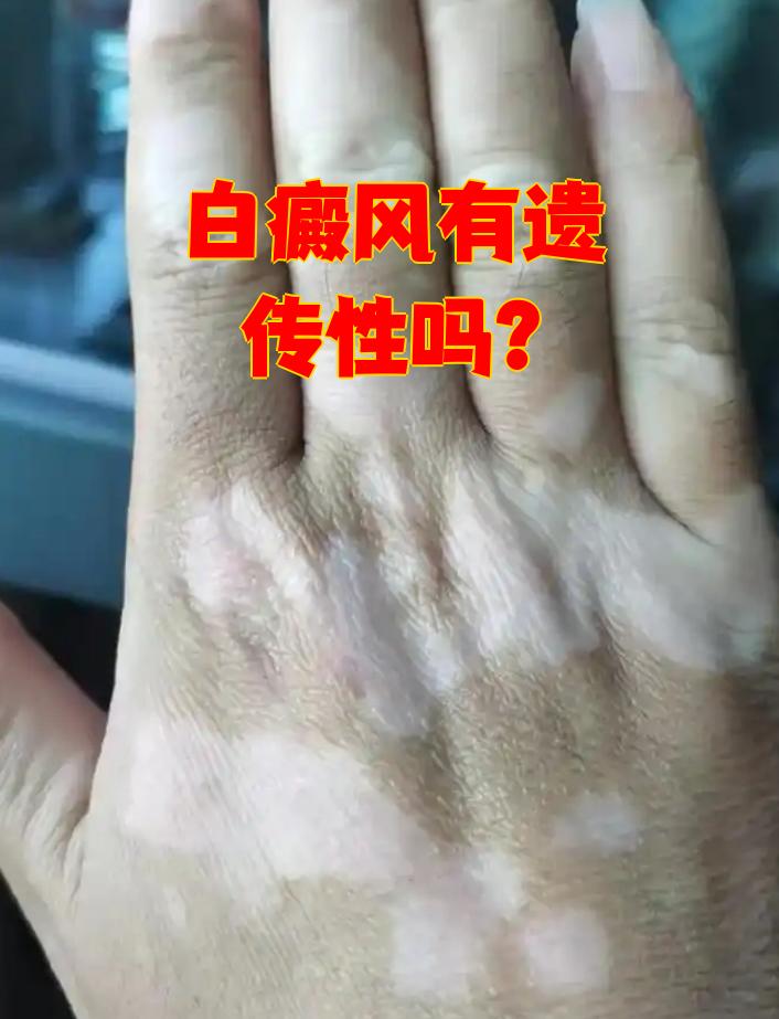 白癜风是会遗传的吗