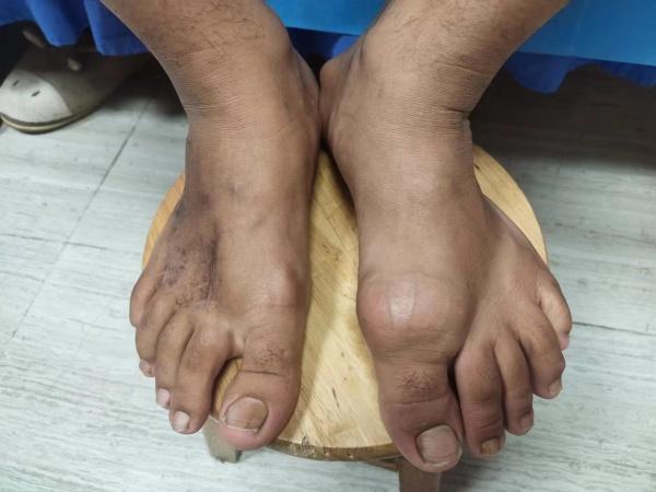 痛风结石如何消除