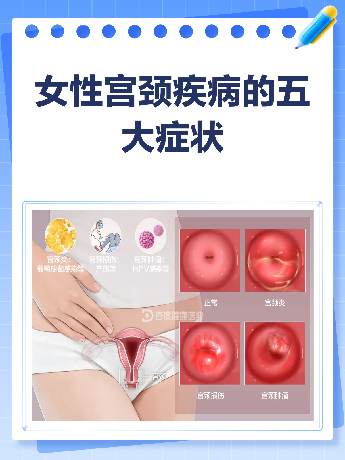 什么事宫颈增生