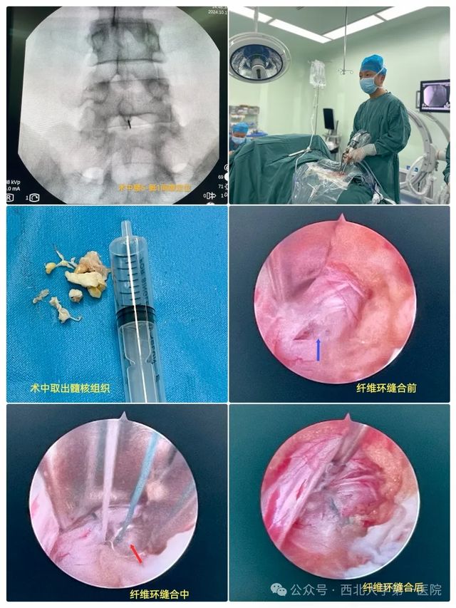 腰椎间盘突出手术