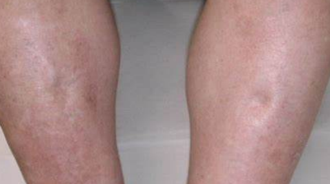 肝腹水的症状表现