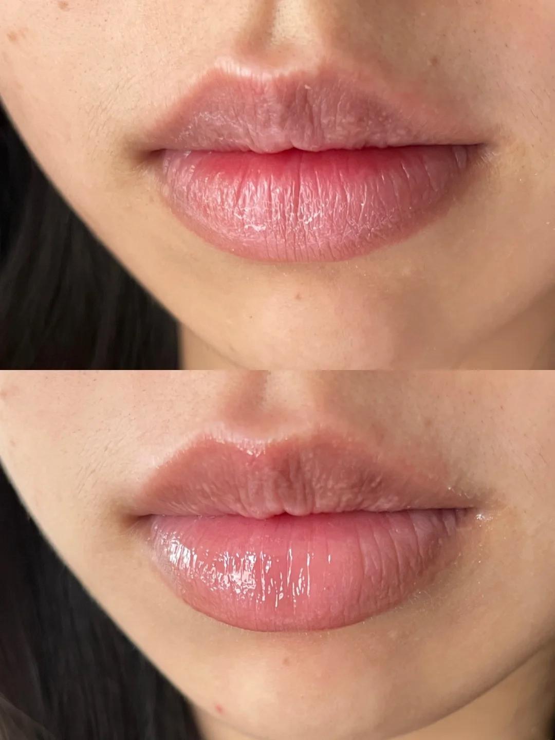 嘴唇干裂脱皮怎么办?